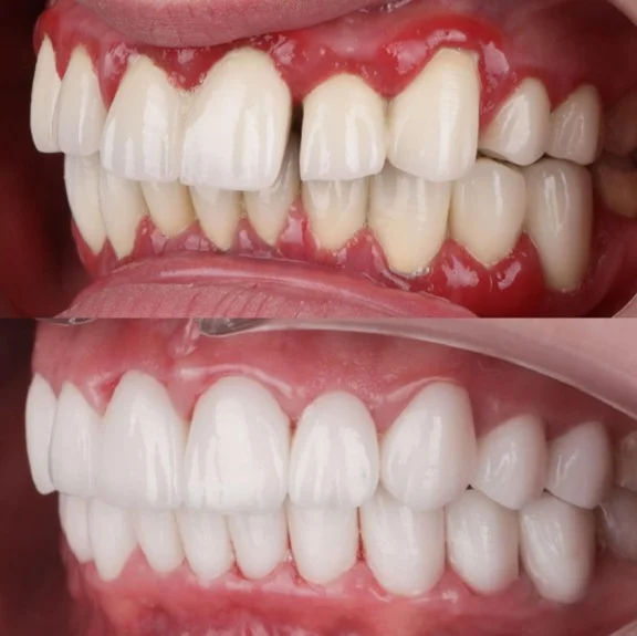 Kako spriječiti krvarenje desni? Saraj Dent savjeti